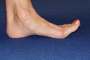 flexed foot pain image