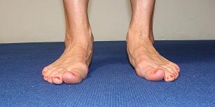 foot pronation image